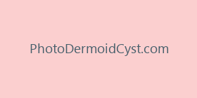 PhotoDermoidCyst.com