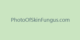 PhotoOfSkinFungus.com