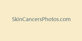 SkinCancersPhotos.com